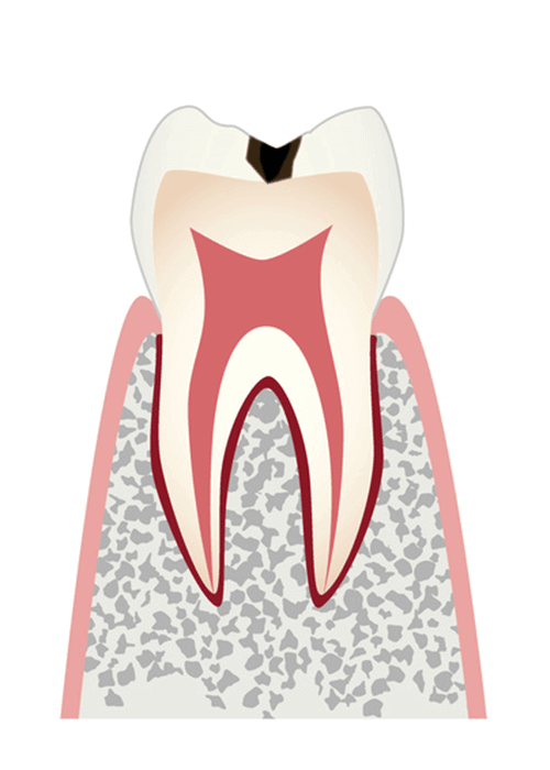 歯の表面の虫歯